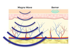 magna-wave-vs-bemer-e1579127482194
